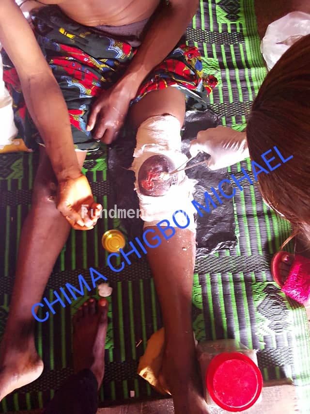 Help Chima Chigbo Michael (a.k.a OBAMA)  To get a knee cap surgery to be able to recover from a fatal accident and get a new knee cap surgery as the former is completely damaged;  I am here to reach out to the GENERAL PUBLIC PLEASE