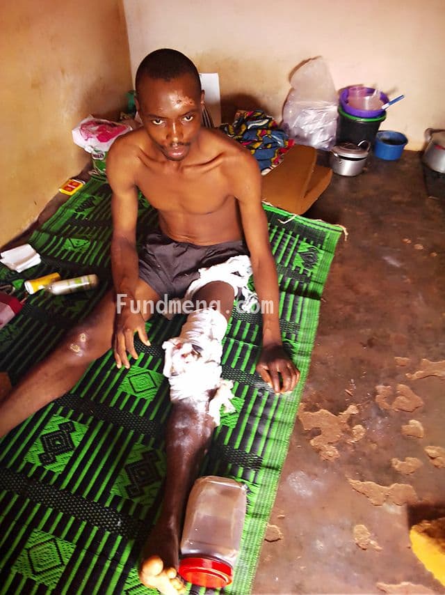 Help Chima Chigbo Michael (a.k.a OBAMA)  To get a knee cap surgery to be able to recover from a fatal accident and get a new knee cap surgery as the former is completely damaged;  I am here to reach out to the GENERAL PUBLIC PLEASE