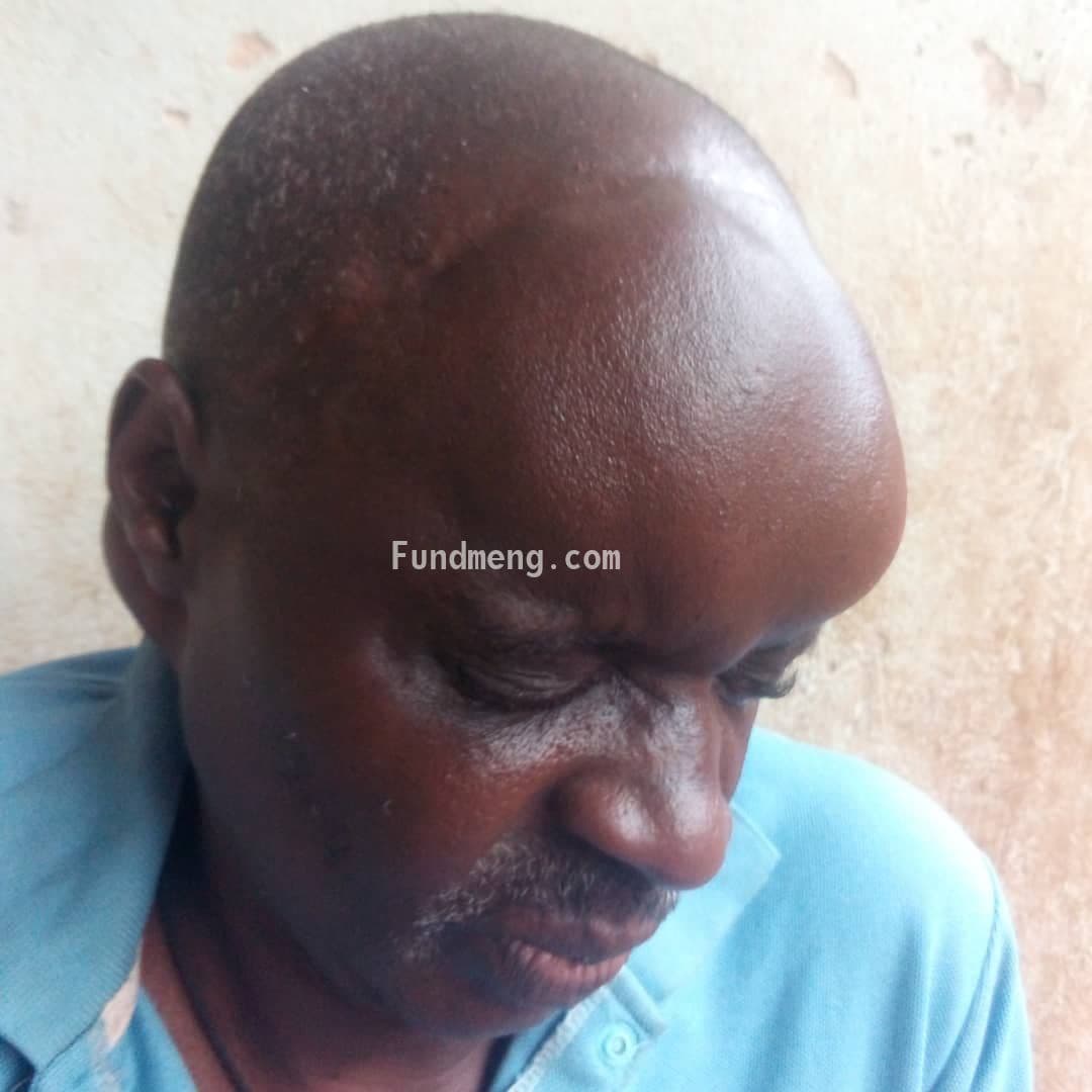 BRAIN SURGERY FOR MR. PAUL TO REMOVE BRAIN TUMOR