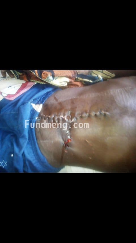 Help medical bill at NATH nnewi Anambra state