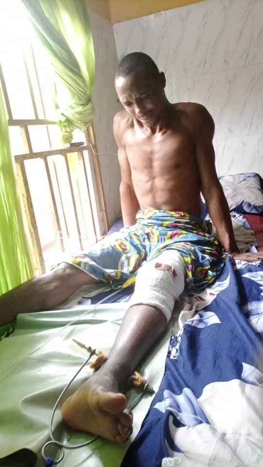 Help Chima Chigbo Michael (a.k.a OBAMA)  To get a knee cap surgery to be able to recover from a fatal accident and get a new knee cap surgery as the former is completely damaged;  I am here to reach out to the GENERAL PUBLIC PLEASE