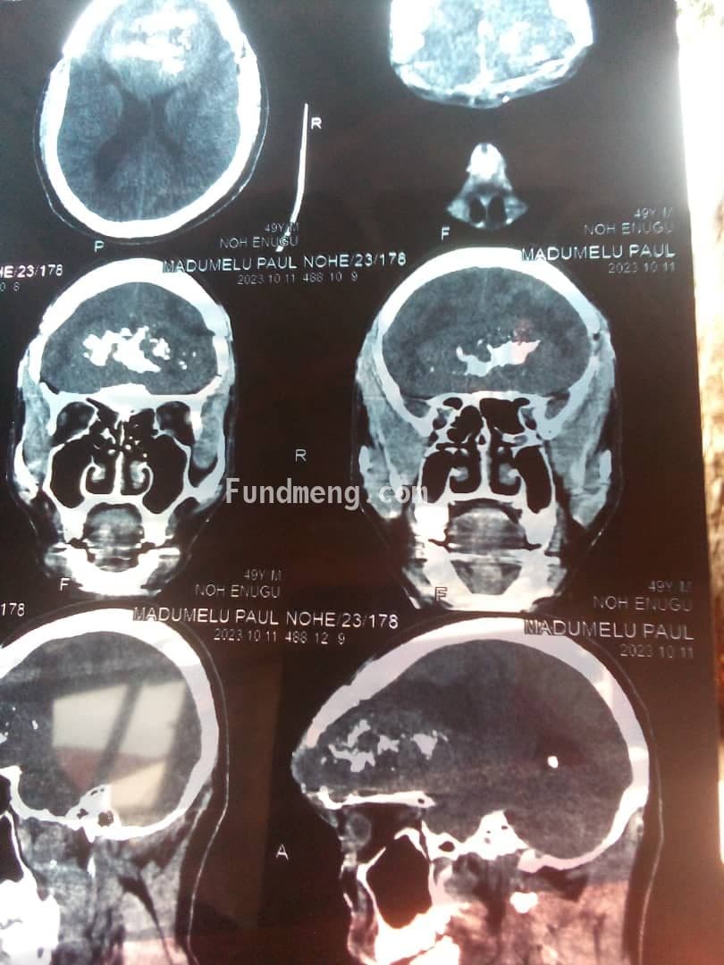 BRAIN SURGERY FOR MR. PAUL TO REMOVE BRAIN TUMOR