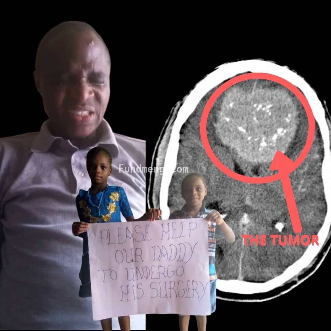 BRAIN SURGERY FOR MR. PAUL TO REMOVE BRAIN TUMOR