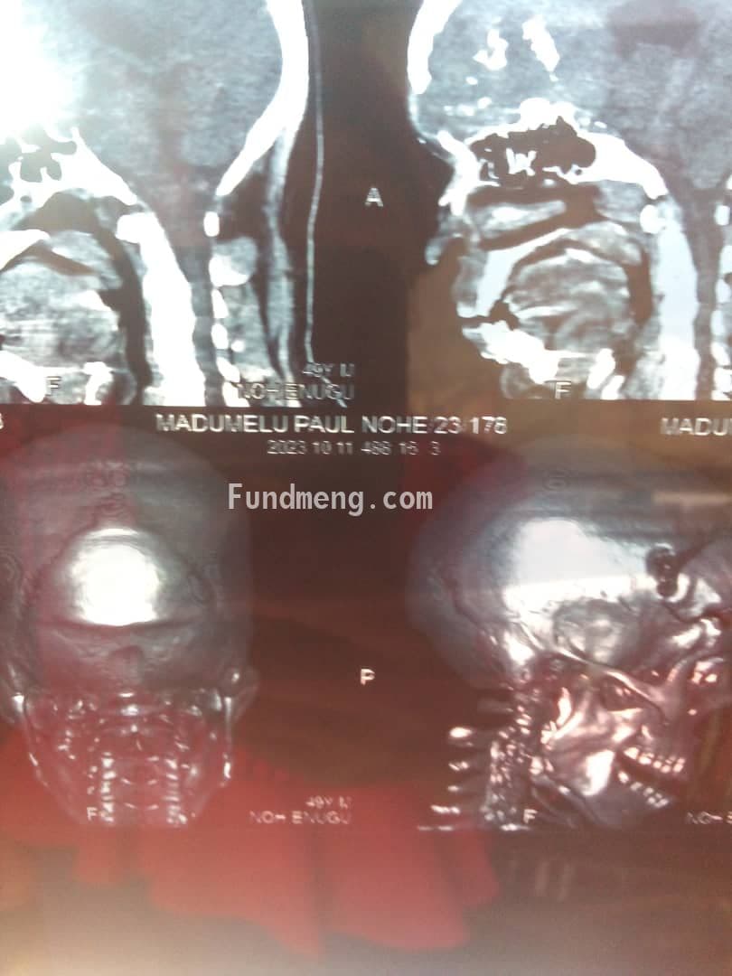 BRAIN SURGERY FOR MR. PAUL TO REMOVE BRAIN TUMOR