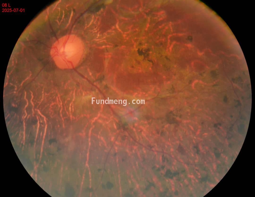 Eye operation