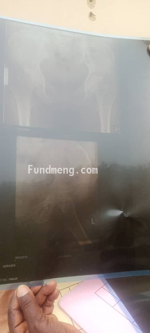 Help MERCY ONGAJI ADESUA Raise Funds To Fight Cervical And Lumber Spondylosis