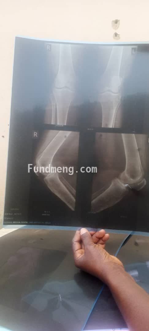 Help MERCY ONGAJI ADESUA Raise Funds To Fight Cervical And Lumber Spondylosis