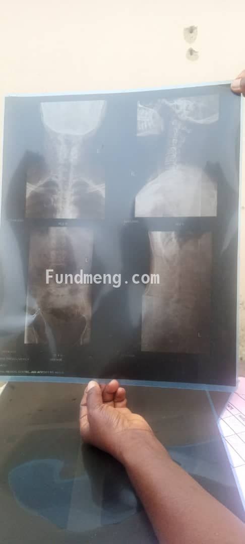 Help MERCY ONGAJI ADESUA Raise Funds To Fight Cervical And Lumber Spondylosis